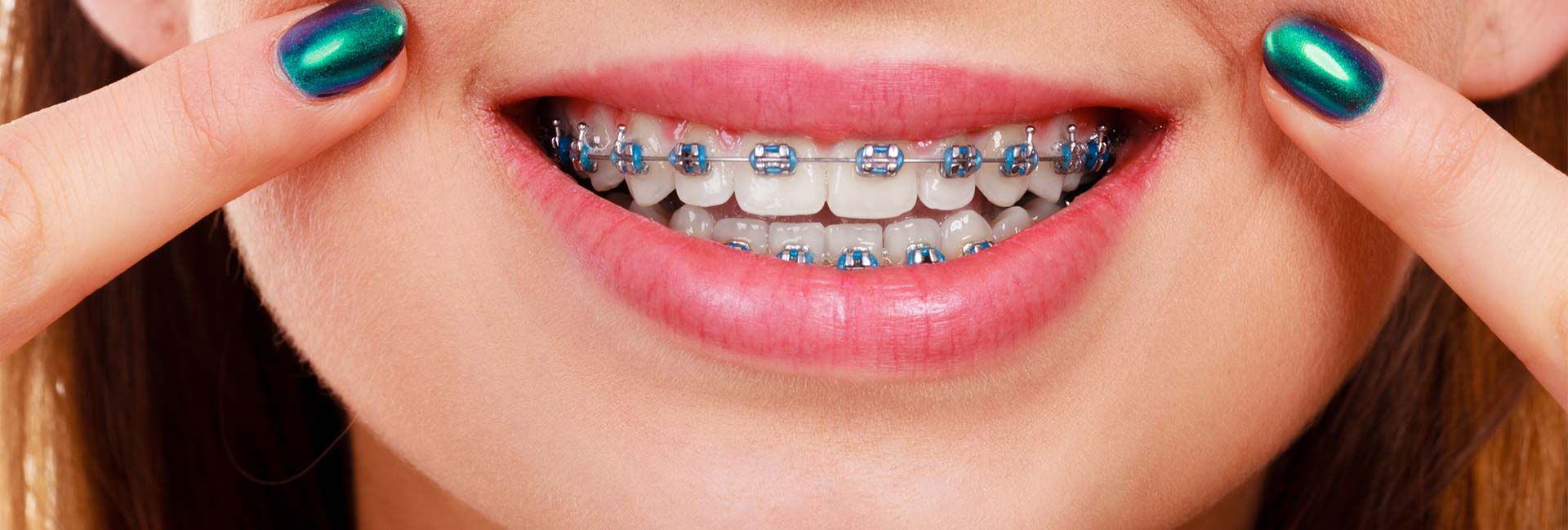 Woman smile showing her white teeth with blue braces